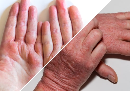 Eczema and Psoriasis: Understanding These Common Skin Conditions